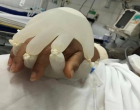 COVID-19: Γιατροί στη Βραζιλία γεμίζουν γάντια με νερό για να μην νιώθουν μόνοι οι ασθενείς